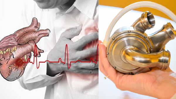 Groundbreaking Medical Trial Australia Man Survives With Artificial Heart Groundbreaking Medical Trial Australia Man Survives With Artificial Heart