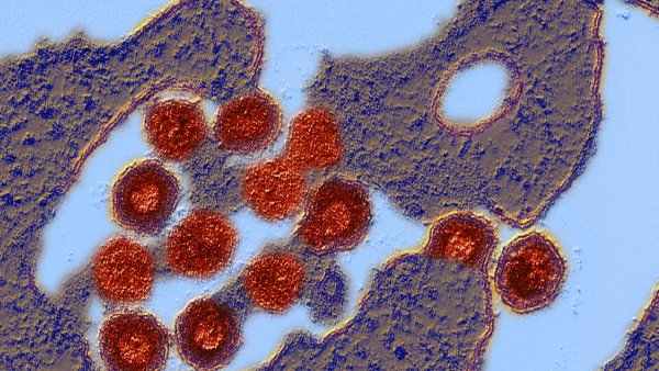 Mysterious virus outbreak in Russia know more about it here