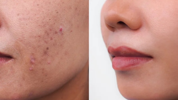 Most secret natural beauty tip for black spot removal and brightness