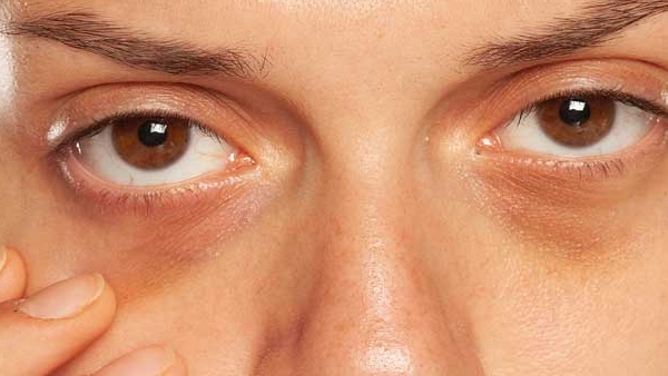 Get rid of dark circles with this home made remedy Which is available in every home