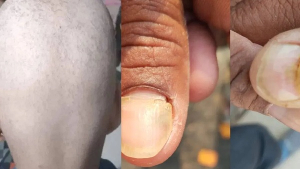 Mysterious disease in maharastra Here is more details about it