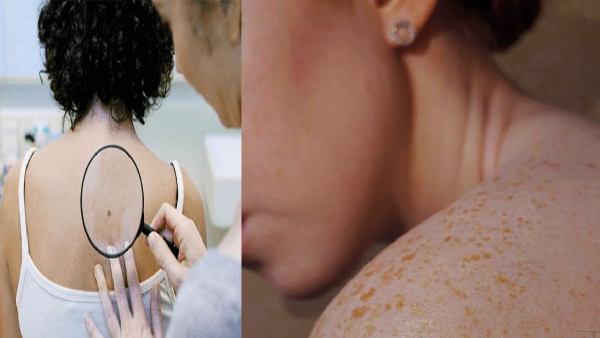 are these changes appearing on your skin it could be skin cancer