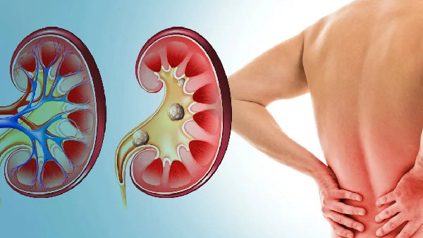 Prevent Kidney Disease 5 Essential Habits for a Healthier Future