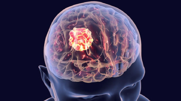 World Brain Tumor Day 2025 Does Your Phone Cause Brain Tumors Signs and Prevention Tips