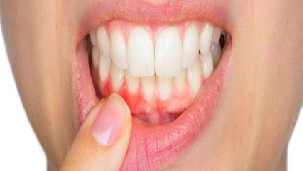 Beyond Tobacco Two Unexpected Causes of Oral Cancer You Need to Know