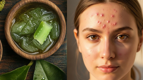 Get Rid of Forehead Pimples Naturally 5 Simple Home Hacks for a Beautiful Clear Forehead