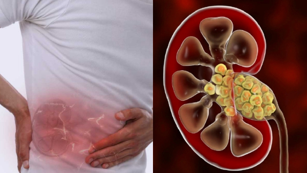 Kidney Stones Is the Pain Different for Men and Women