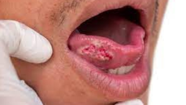 Beyond Tobacco Two Unexpected Causes of Oral Cancer You Need to Know