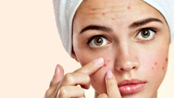 Reason for pimples on face and stop these habits to say goodbye to pimples forever