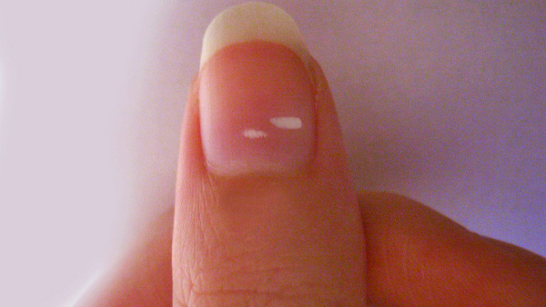 Cracks Ridges and Spots Decoding the Health Warnings on Your Nails