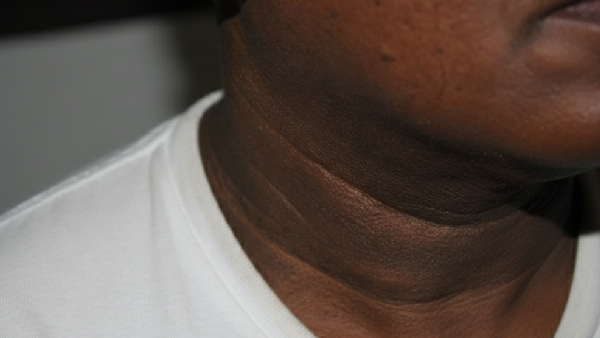 Acanthosis Nigricans Understanding Darkening Skin in the Neck and Armpits