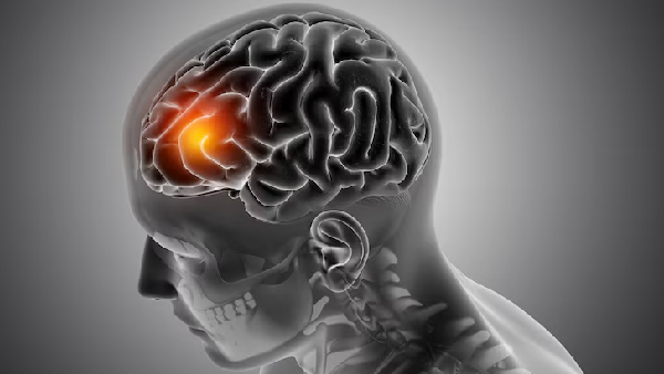 Are You at Risk for a Stroke Know These Risk Factors