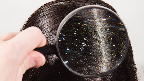 Winter Dandruff Trouble Simple Home Remedies That Actually Work