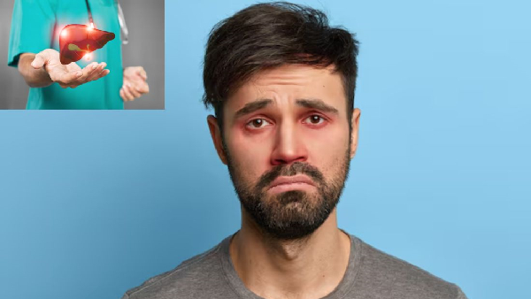 Not a Drinker You re Still at Risk Watch Out for These Fatty Liver Symptoms on Your Face