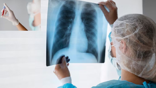 Medical Breakthrough Scientists Develop Blood Test to Detect Lung Cancer Early