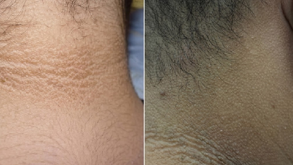 Acanthosis Nigricans What Your Dark Neck is Trying to Tell You About Your Health Acanthosis Nigricans What Your Dark Neck is Trying to Tell You About Your Health