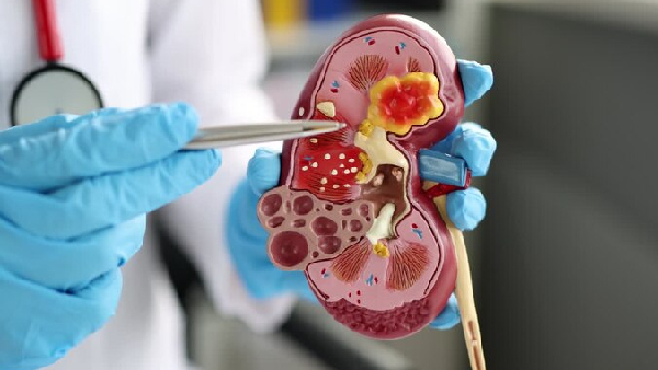 Why Kidney Stones Are Dangerously Common in Summer And How to Avoid Them