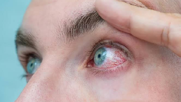 Red Itchy and Watery Eyes Conjunctivitis Symptoms Causes and Home Care for Pink Eye Red Itchy and Watery Eyes Conjunctivitis Symptoms Causes and Home Care for Pink Eye