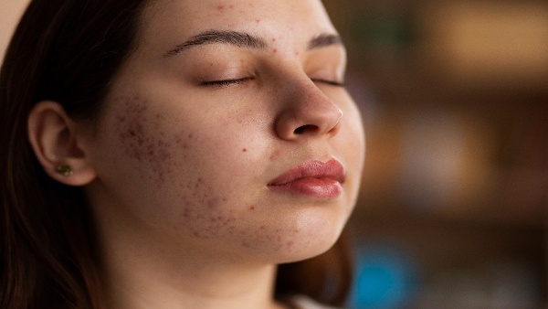Physical and hormonal changes of facial acne tips and suggestions to prevent it Physical and hormonal changes of facial acne tips and suggestions to prevent it