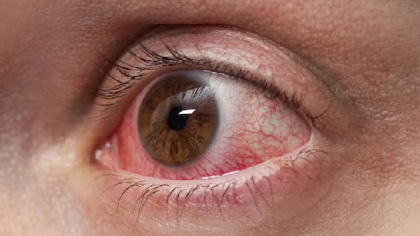 Red Itchy and Watery Eyes Conjunctivitis Symptoms Causes and Home Care for Pink Eye Red Itchy and Watery Eyes Conjunctivitis Symptoms Causes and Home Care for Pink Eye