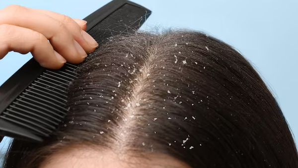 Does Dandruff Really Cause Baldness Here s the Ultimate Cure for Dandruff Does Dandruff Really Cause Baldness Here s the Ultimate Cure for Dandruff