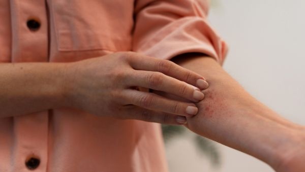 World Mosquito Day be cautious after a mosquito bite Do not ignore these symptoms