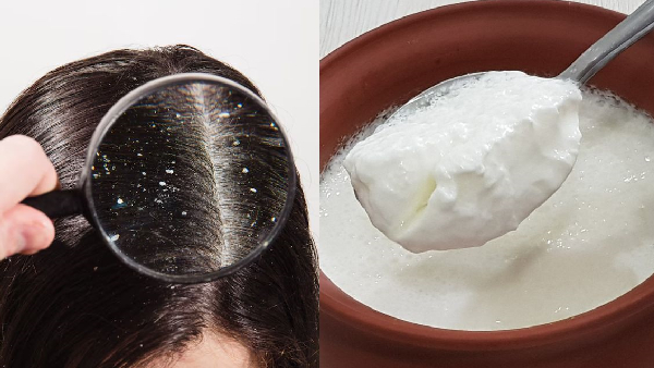 Tired of Dandruff Flakes Try Grandma s Secret Curd Hack Tired of Dandruff Flakes Try Grandma s Secret Curd Hack