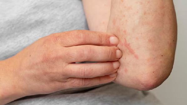 Struggling with Sudden Skin Allergies Cure Them Naturally with Zero Side Effects Struggling with Sudden Skin Allergies Cure Them Naturally with Zero Side Effects