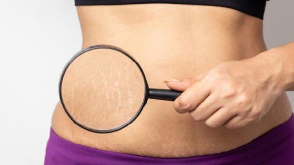 Home made remedies to prevent stretch marks on skin for women Home made remedies to prevent stretch marks on skin for women
