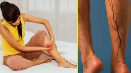 Vitamin Deficiency and Leg Cramps: Which Vitamin Deficiency Causes Leg pain ?