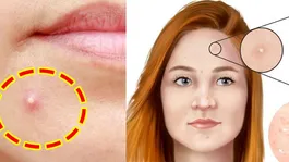 Chehre Par Safed Funsi Ka Ilaj: Kyu Hoti Hai,Kaise Theek Kare ?