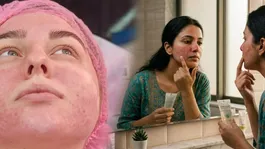 Garmi Me Chehra Lal Ho Jaye To Kya Kare: Home Remedy In Hindi