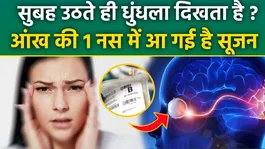 Optic Nerve Swelling Treatment: Subah Uthate Hi Dhundhla Dikhne Ka Karan,Ilaj | Causes In Hindi