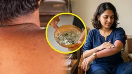 Summer Skin Rashes: What to Do If Your Skin Gets Irritated or Burnt by Sweat During the Summer |