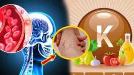 Vitamin K Deficiency Disease: What Illnesses Are Caused by Vitamin K Deficiency, Symptoms