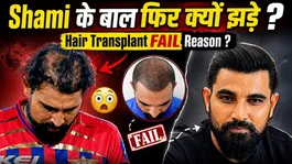 Mohammed Shami Hair Transplant Failed? Why Hair Fall Continued After Spending Lakhs!