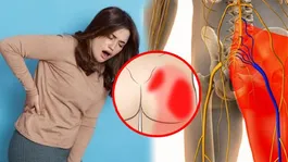 Sciatica Pain Relief: Kulhe Ki Nas Dabne Ka Karan,Lakshan Aur Ilaj | Hip Nerve Block Symptoms