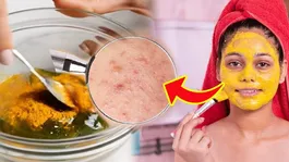 Chehre Par Gadde Mitane Ke Liye Cream: Acne Scars Treatment