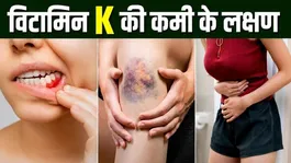 Vitamin K Deficiency Symptoms: Vitamin K Ki Kami Ke Lakshan,Kaise Theek Kare ?