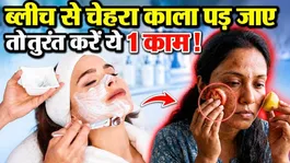 Treating Bleach Burns: What to do if your face darkens after bleaching,Home remedies for the face |