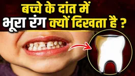 Teeth Brown Stain Removal: Bacche Ke Dant Me Bhura Dhaag Hone Ka Karan,Ilaj Kya Hai ?