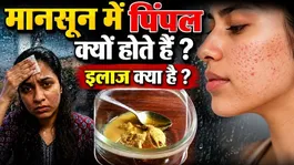 Acne in Monsoon Season: Why do pimples occur during the monsoon, and what to do if you get acne?