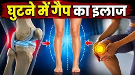 Knee Gap Reason: Ghutne Me Gap Ka Ilaj,Haddi me gap ho to kya kare ?