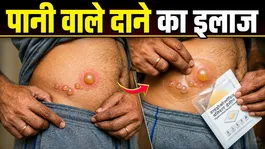 Water Blisters Treatment At Home: Pani Wale Dane Ka Gharelu Ilaj,Funsi Kyu Hoti Hai ?