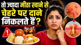 Can Sugar Cause Acne? Doctor Explains How Excess Sugar Triggers Pimples