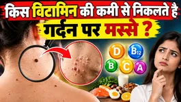 Which Vitamin Deficiency Causes Warts? Real Reason &amp; Cure! | Warts Removal Tips