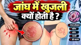 Thigh Ringworm Treatment: Jangh Me Dad Kyu Hota Hai,Khujli Ka ilaj |Home Remedy