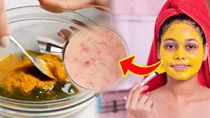 Chehre Par Gadde Mitane Ke Liye Cream: Acne Scars Treatment