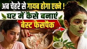 Acne Prone Face Pack At Home: Pimple Ke Liye Face Pack,Best Home Remedy| Ghar Me Kaise Banaen ?