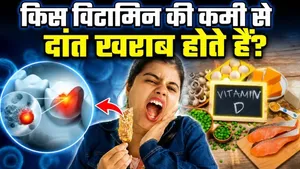 Vitamin Deficiency: Which vitamin deficiency causes tooth damage? Symptoms, Treatment...|